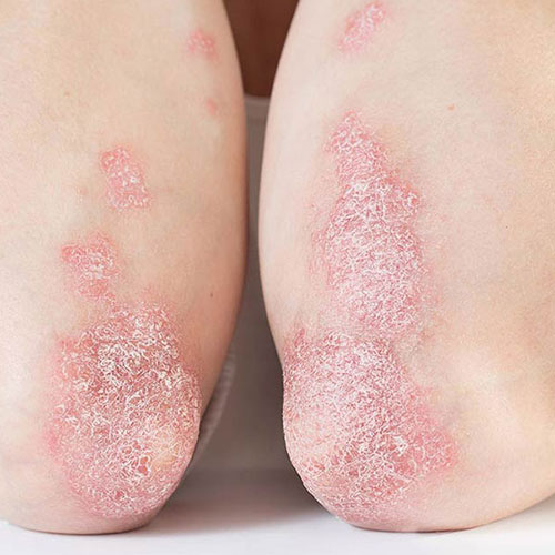 بیماری پوستی