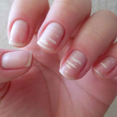 بیماری های ناخن 